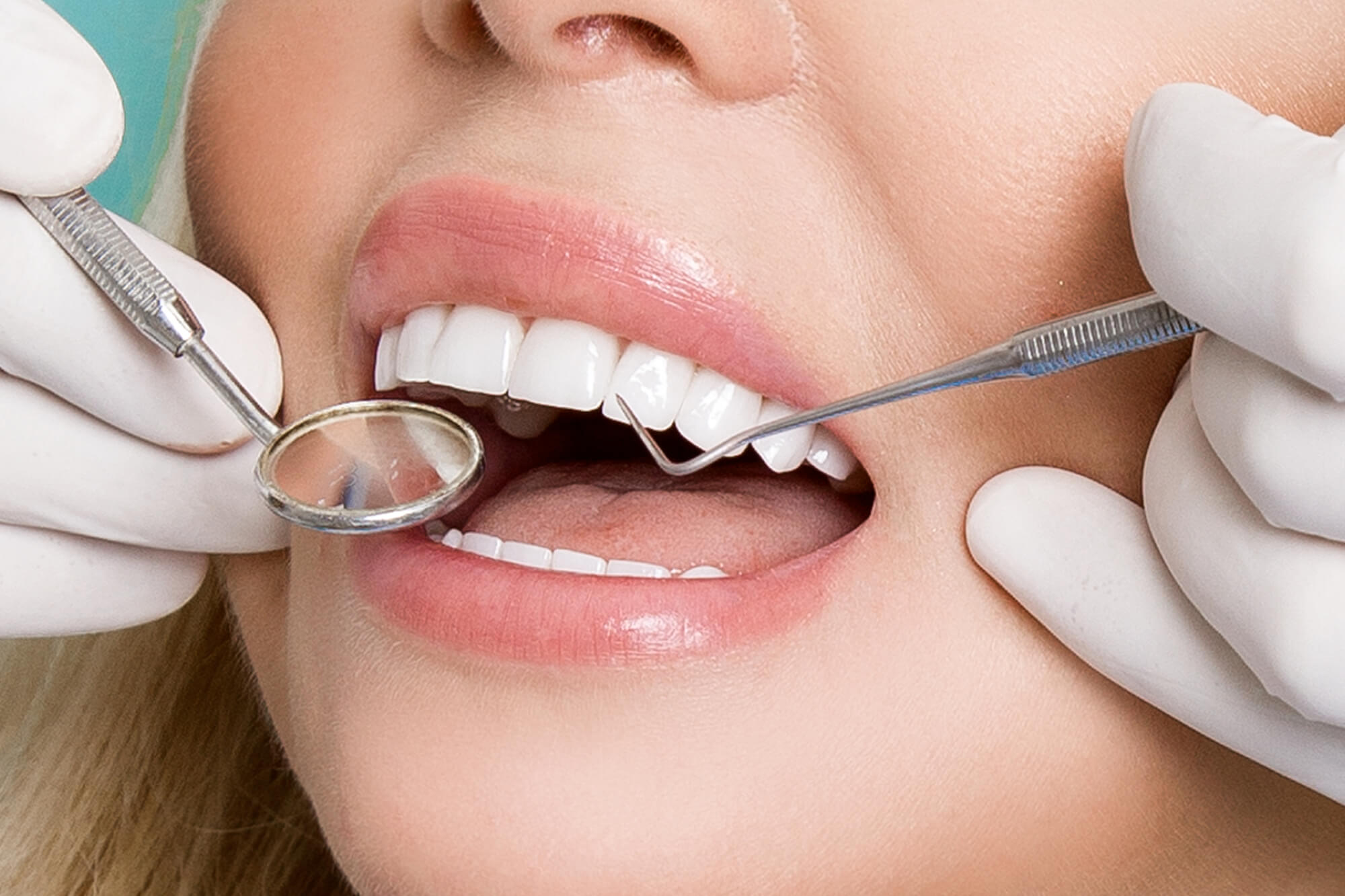 Teeth Whitening From Elements Dental Spa & Aesthetics