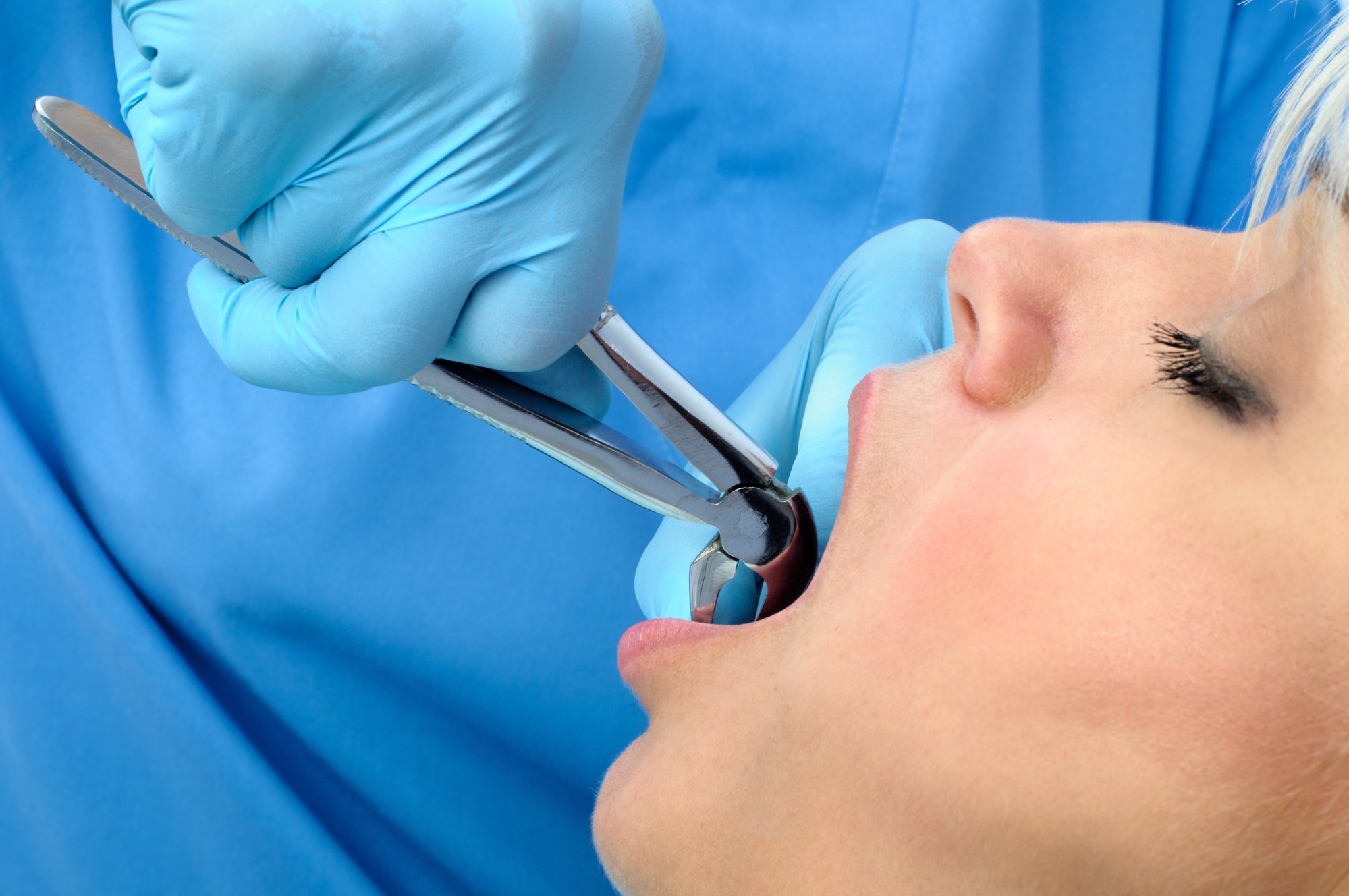 Preparation and Recovery Time for Multiple Tooth Extractions| Elements ...