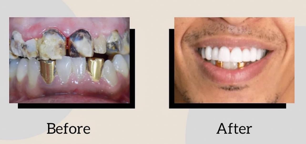 before and after crown veneers result