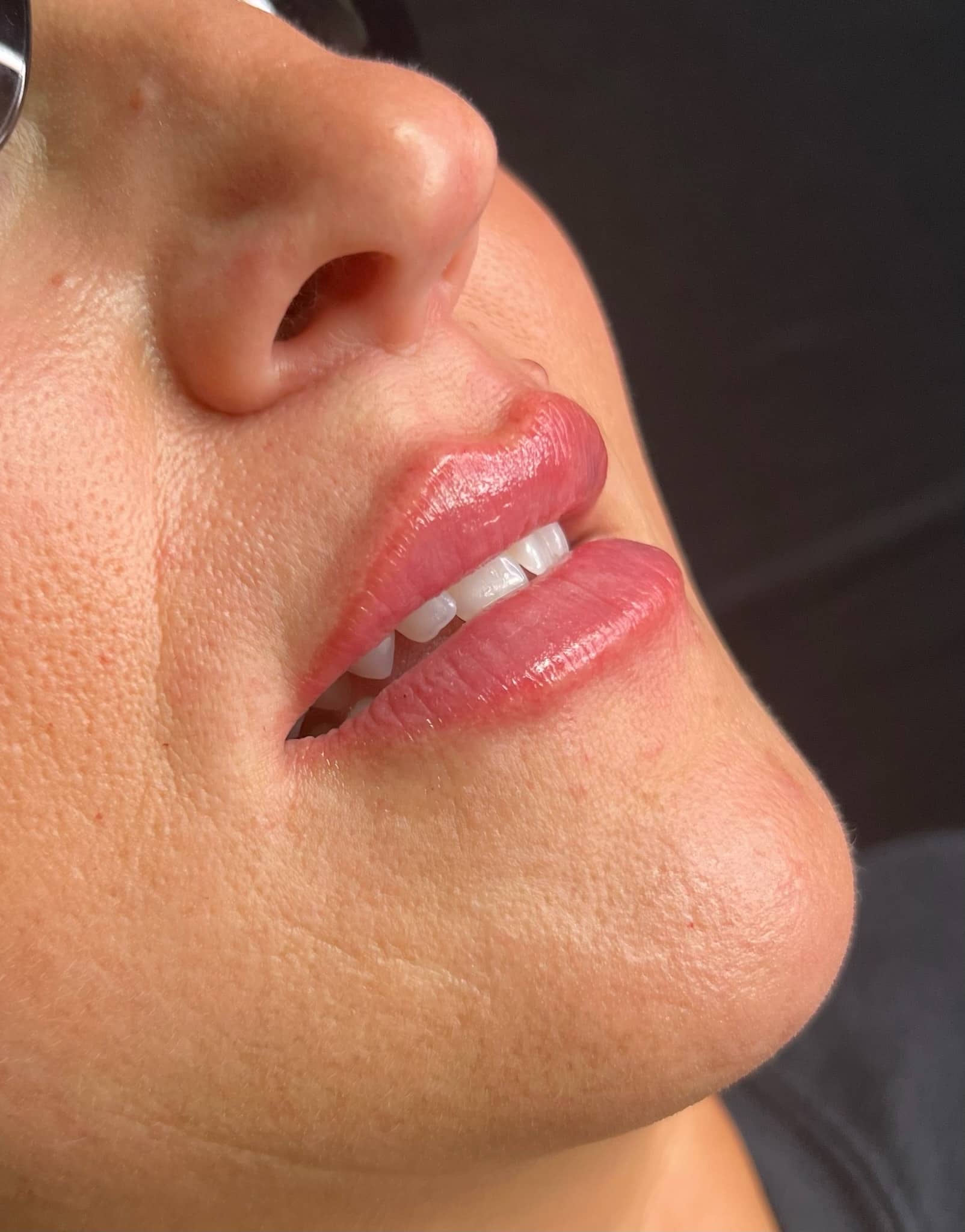Close-up of a person's mouth enhanced by dermal fillers in Elements Dental Spa