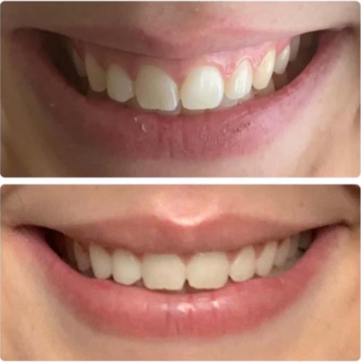 gum contouring