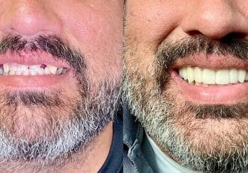 Veneers before and after result