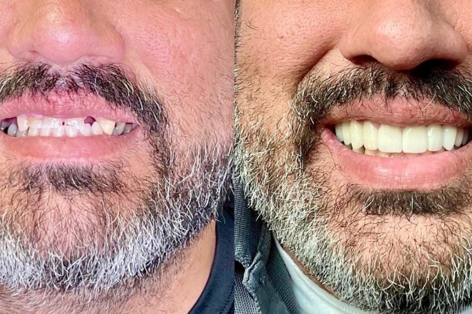 Veneers before and after result