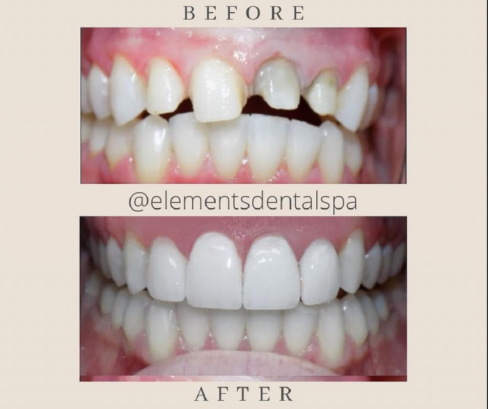 Side-by-side comparison of teeth before and after dental treatment, showing improved alignment and color in the "after" image.